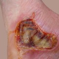 Understanding the Different Degrees of Burns: An Expert's Perspective