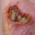 Understanding First-Degree Burns: What They Look Like and How to Treat Them