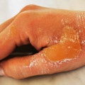 Understanding the Different Degrees of Burns: An Expert's Perspective