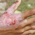 Understanding Burn Injuries: Types, Treatment, and Recovery