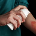 The Denuded Skin Wound Meaning You Need to Know When Treating First-Degree Burns