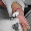 Essential Knowledge On First Degree Chemical Burn Stages For Quick Recovery