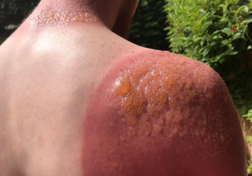 When to Seek Medical Help for Second-Degree Sunburns: A Medical Professional's Perspective