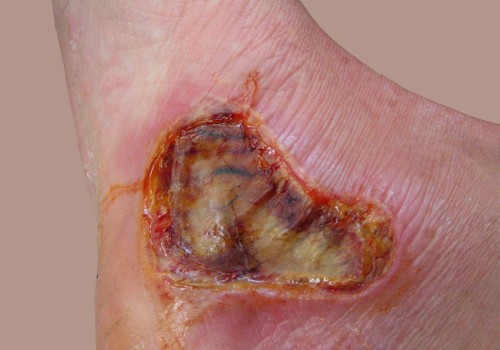 Understanding the Different Degrees of Burns: An Expert's Perspective