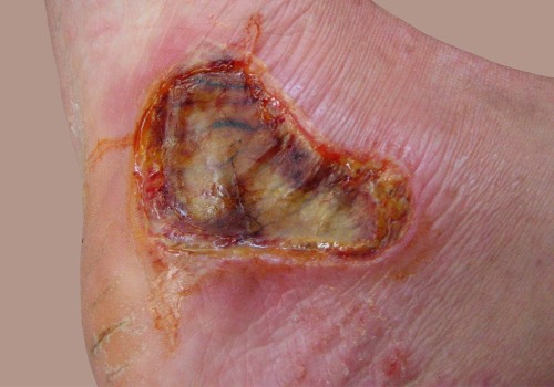 Understanding First-Degree Burns: What They Look Like and How to Treat Them