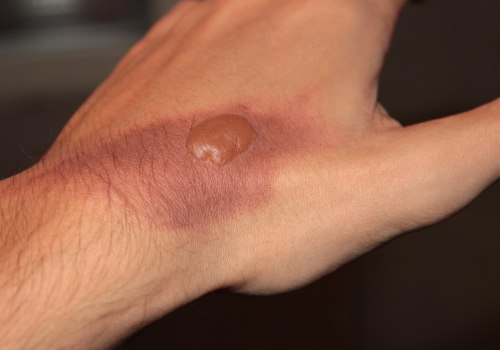 The Different Degrees of Burns: A Comprehensive Guide to Understanding Severity and Treatment