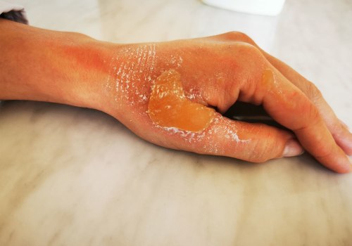 Understanding the Different Degrees of Burns: An Expert's Perspective