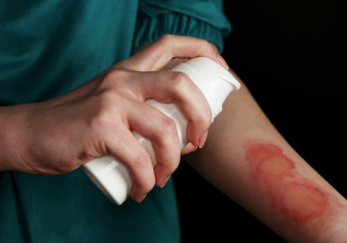 The Denuded Skin Wound Meaning You Need to Know When Treating First-Degree Burns