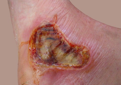 Expert Tips for Identifying 2nd and 3rd Degree Burns: A Comprehensive Guide