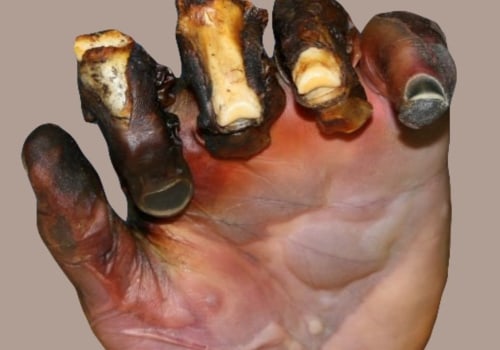 The 7 Degrees of Burns: A Comprehensive Guide to Understanding Burn Injuries